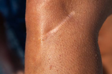 Ameliyat sonrası bir yaranın yakın çekimi terli ciltte iyileşme, cilt sağlığı ve tıbbi iyileşme.