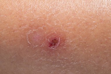 Hasarlı cildin yakın çekimi, yaşla ilgili değişiklikler ve potansiyel sağlık kaygılarının vurgulanması