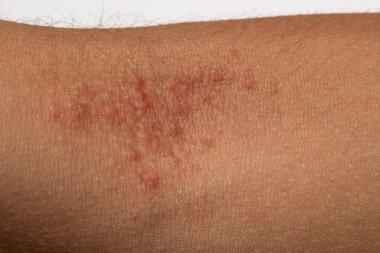 Cilt alerjisi belirtileri insan kolunda kızarıklık olduğunu gösteriyor.