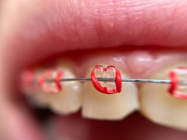 Diş telleri süper makro, çarpık dişler, kırık safir teller.