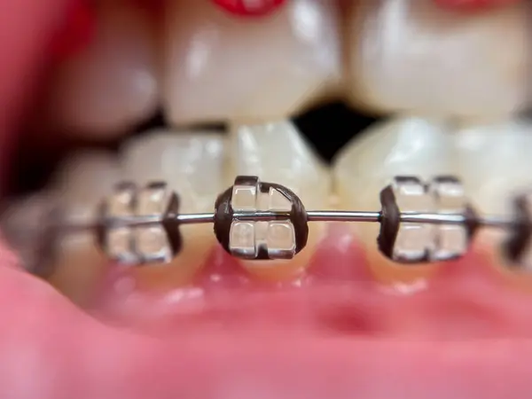 Diş telleri süper makro, çarpık dişler, kırık safir teller.