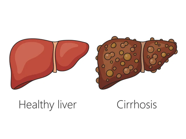 stock vector Healthy liver and liver with cirrhosis disease schematic vector illustration. Medical science educational illustration