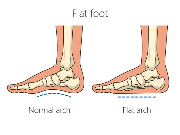 平らな足の骨の回路図ベクトル図 医学教育図 — ストックベクタ