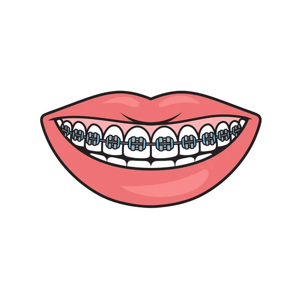 Dental Braces Teeth Smile Schematic Diagram Vector Illustration Medical Science — Stock Vector