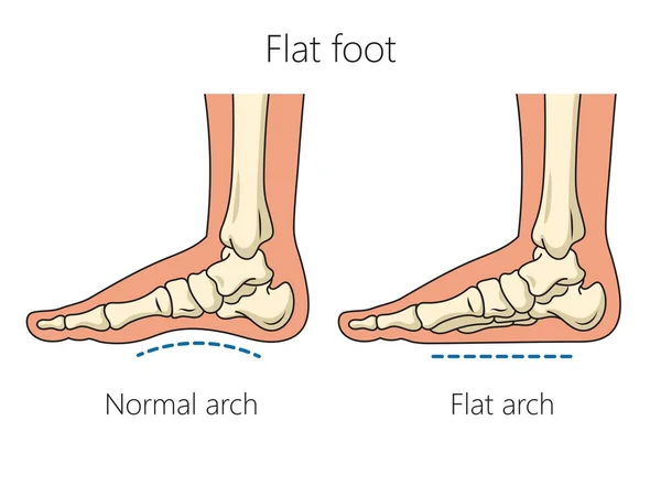 平らな足の骨の回路図ラスター図 医学教育図 — ストック写真