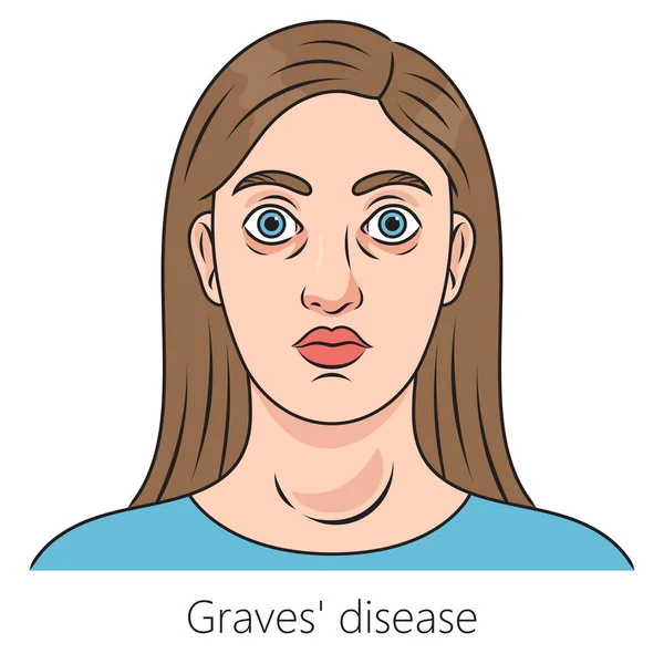 Wanita Dengan Penyakit Graves Skema Skema Diagram Goiter Graves Ilustrasi - Stok Vektor