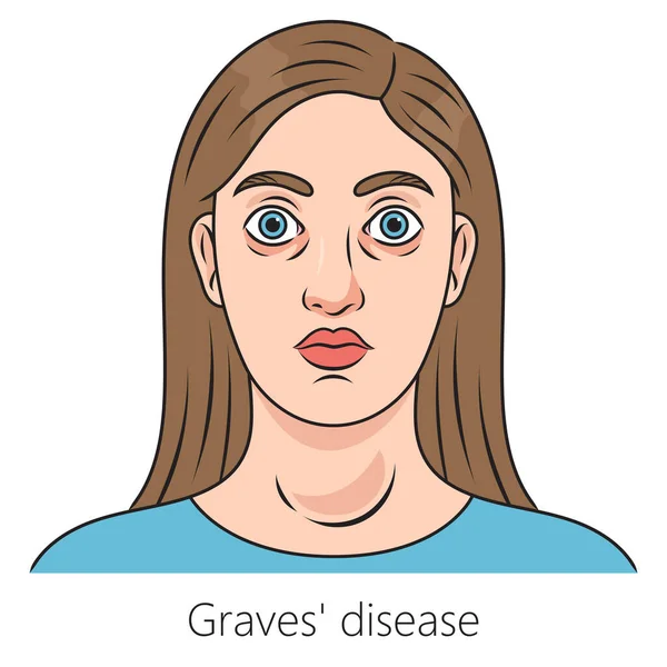 Kobieta Chorobą Grobową Toksyczne Rozproszone Goiter Diagram Schematyczna Ilustracja Rastrowa — Zdjęcie stockowe