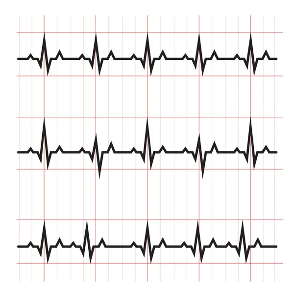 正常および異常Ecg心臓図回路図ベクトル図 医学教育図 — ストックベクタ