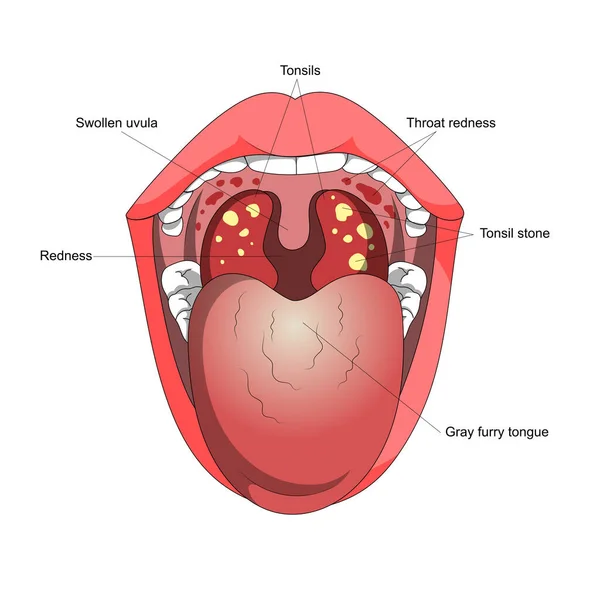 扁桃腺炎ヒトの喉の炎症疾患口の図回路図ベクトル図 医学教育図 — ストックベクタ
