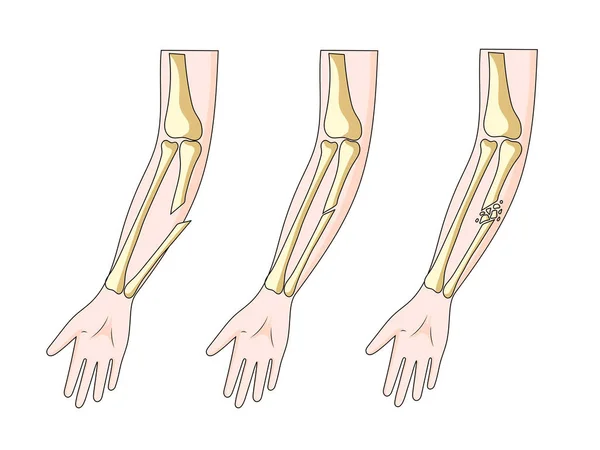 Tipos Fraturas Ossos Mão Diagrama Esquemático Ilustração Vetorial Ilustração Educacional —  Vetores de Stock