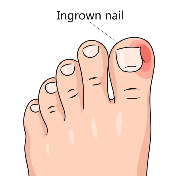 Ingrown Nail Onychocryptosis Diagram Schematic Vector Illustration Medical Science Educational — Stock Vector