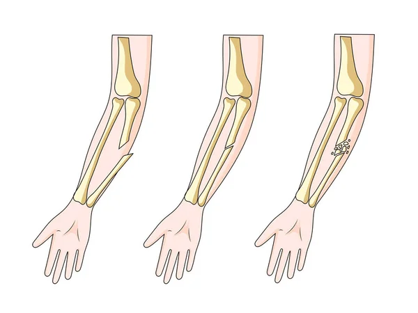 Typer Hand Ben Frakturer Diagram Schematisk Raster Illustration Medicinsk Vetenskap — Stockfoto