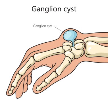 Ganglion kist yapı hastalığı şematik vektör çizimi. Tıp bilimi eğitimsel illüstrasyon