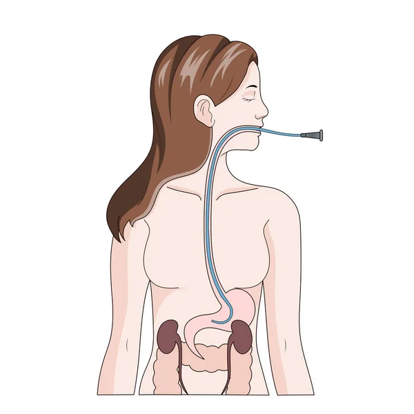 Nasogastrische Intubatie Diagram Schematische Vector Illustratie Educatieve Illustratie Medische Wetenschappen — Stockvector