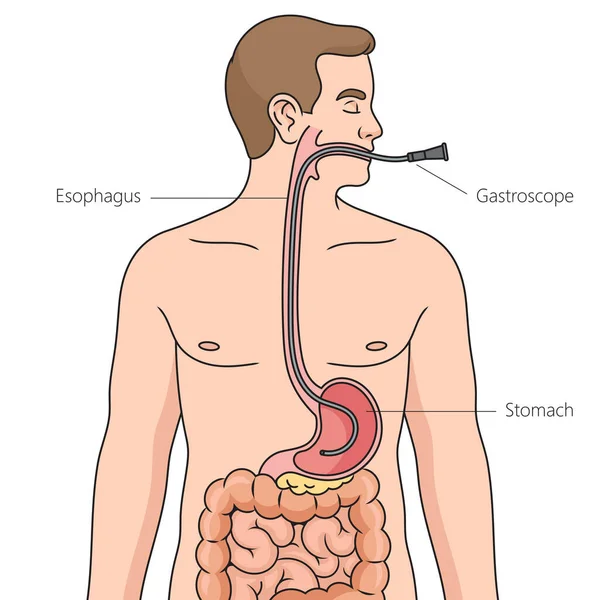 Ilustracja Wektora Intubacji Nosowo Żołądkowej Medycyna Nauka Edukacyjna Ilustracja — Wektor stockowy