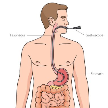 Nasogastrik entübasyon diyagramı şematik raster çizimi. Tıp bilimi eğitimsel illüstrasyon