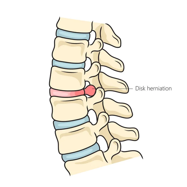 Diagrama Hernia Discal Espinal Ilustración Trama Esquemática Ilustración Educativa Ciencias —  Fotos de Stock