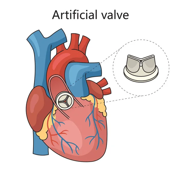 Τεχνητή Βαλβίδα Καρδιάς Στην Απεικόνιση Σχηματοποιημένου Σχήματος Διαγραμμάτων Ανθρώπινης Καρδιάς — Φωτογραφία Αρχείου