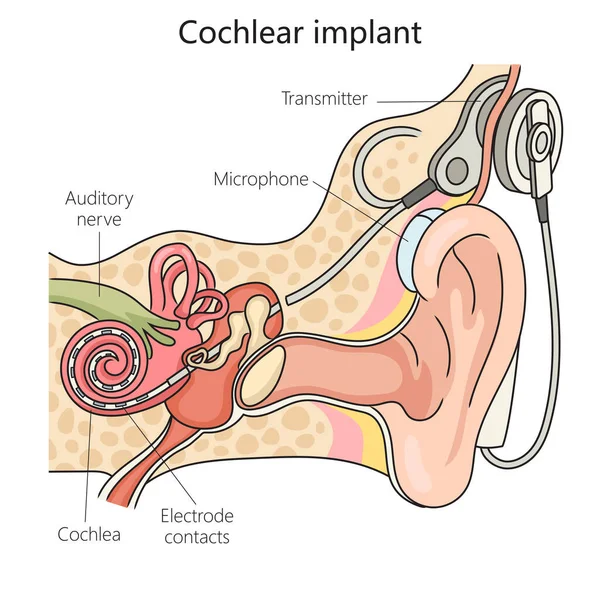 Cochleair Implantaat Structuur Wervelkolom Diagram Schematische Raster Illustratie Educatieve Illustratie — Stockfoto