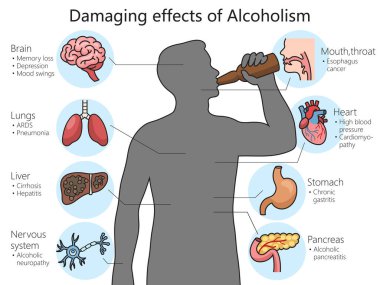 Alkolün insan vücudundaki zararlı etkileri şematik vektör çizimi üzerinde. Tıp bilimi eğitimsel illüstrasyon
