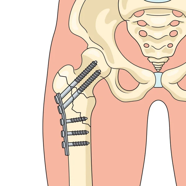 Ortopedi Cerrahi Dalında Sabitleme Operasyonu Kemik Diyagramı Şematik Raster Çizimi — Stok fotoğraf