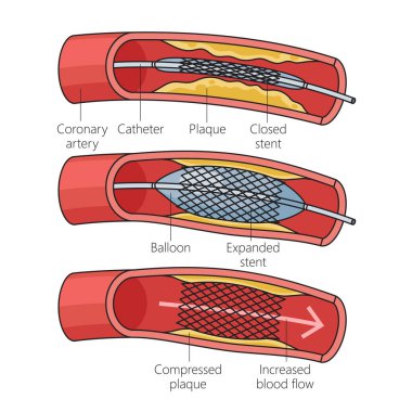 Koroner stent yerleştirme şematik vektör illüstrasyonunun diyagramı. Tıp bilimi eğitimsel illüstrasyon