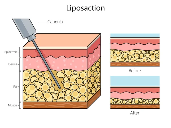 Liposuction yağ aldırma prosedürü şematik vektör çizimi. Tıp bilimi eğitimsel illüstrasyon