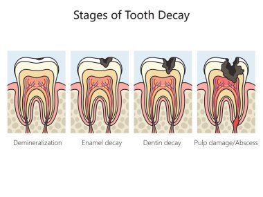 Tooth decay caries stages diagram schematic raster illustration. Medical science educational illustration clipart
