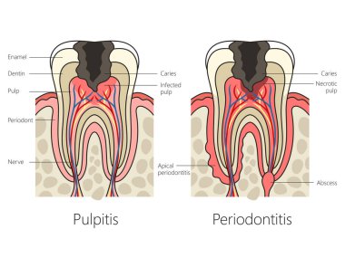 Pulpitis ve insan dişlerindeki periodontit şematik raster çizimi. Tıp bilimi eğitimsel illüstrasyon