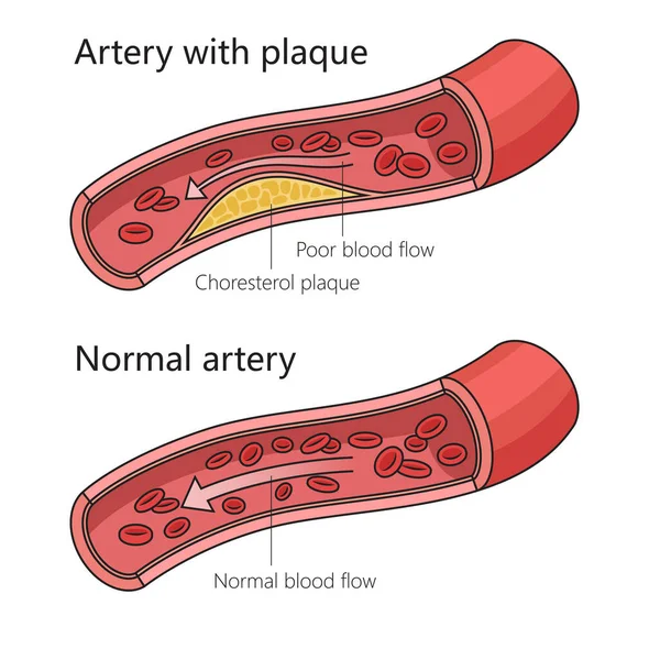 Aterosclerosis Arteriosclerotic Vascular Disease Artery Plaque Diagram Schematic Raster Illustration —  Fotos de Stock