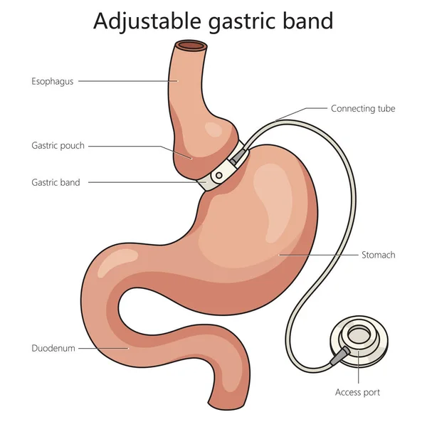 stock vector Adjustable gastric band stomach band structure diagram schematic vector illustration. Medical science educational illustration