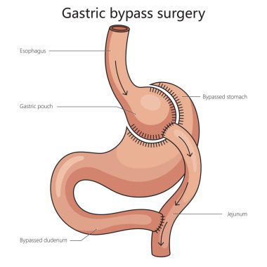 Gastrik baypas ameliyatı mide bölünmüş diyagram şematik vektör çizelgesidir. Tıp bilimi eğitimsel illüstrasyon