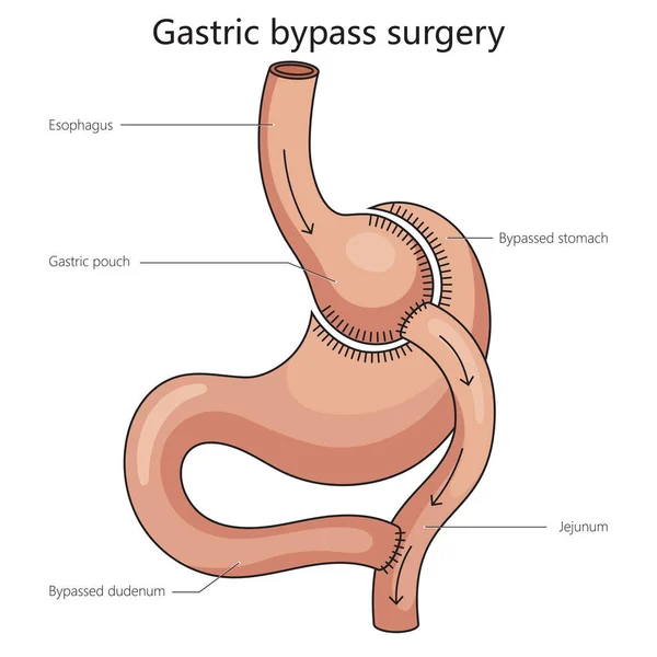 Gastrico Bypass Chirurgia Dello Stomaco Diviso Diagramma Schematico Raster Illustrazione — Foto Stock