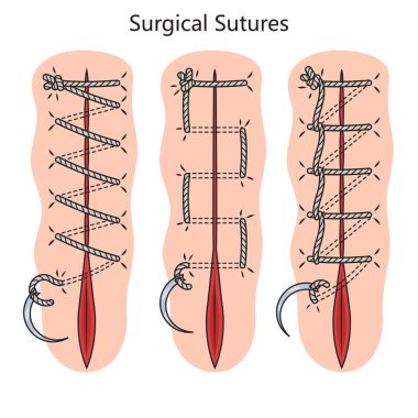 Cerrahi dikiş diyagramı şematik vektör çizimi. Tıp bilimi eğitimsel illüstrasyon