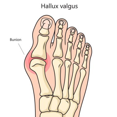 Hallux valgus nasır yapısı vertebral sütun diyagramı şematik raster çizimi. Tıp bilimi eğitimsel illüstrasyon