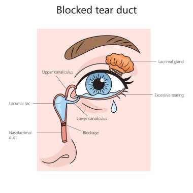 Göz yaşı kanalı diyagramını engelledi. El çizimi şematik raster çizimi. Tıp bilimi eğitimsel illüstrasyon