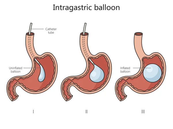 Mide Içi Balon Yapısı Diyagramı Çizimi Şematik Raster Çizimi Tıp — Stok fotoğraf