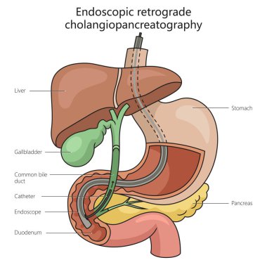 Endoscopic retrograde cholangiopancreatography structure vertebral column diagram hand drawn schematic raster illustration. Medical science educational illustration clipart