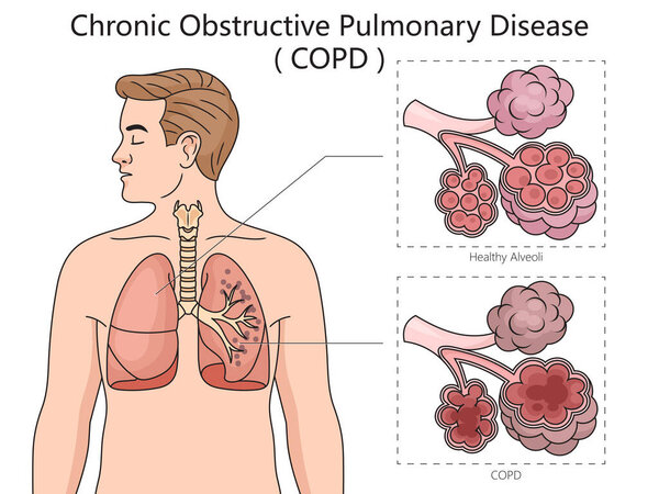 Хроническая обструктивная болезнь легких ХОБЛ диаграмма руки нарисована схематической векторной иллюстрацией. Образовательная иллюстрация