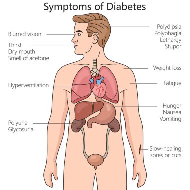 Diyabet belirtileri el çizimi şematik raster çizimi. Tıp bilimi eğitimsel illüstrasyon