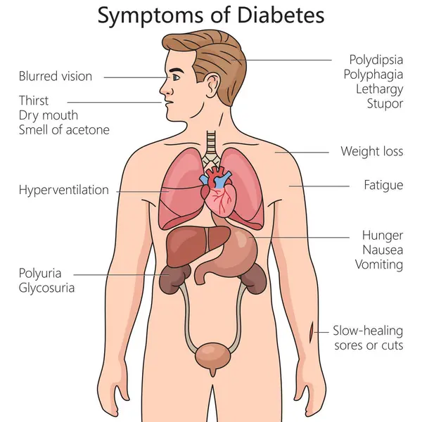 Diyabet belirtileri el çizimi şematik raster çizimi. Tıp bilimi eğitimsel illüstrasyon