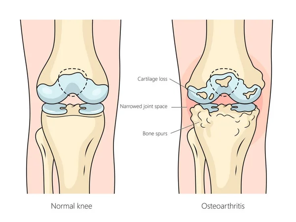 膝関節構造図手のヒトOsteoarthritisレオマトイド関節炎図は 回路ベクター図を描画しました 医学教育イラスト — ストックベクタ