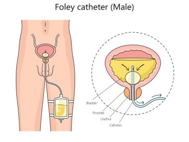 Erkek foley idrar kateteri yapı diyagramı el çizimi şematik raster çizimi. Tıp bilimi eğitimsel illüstrasyon