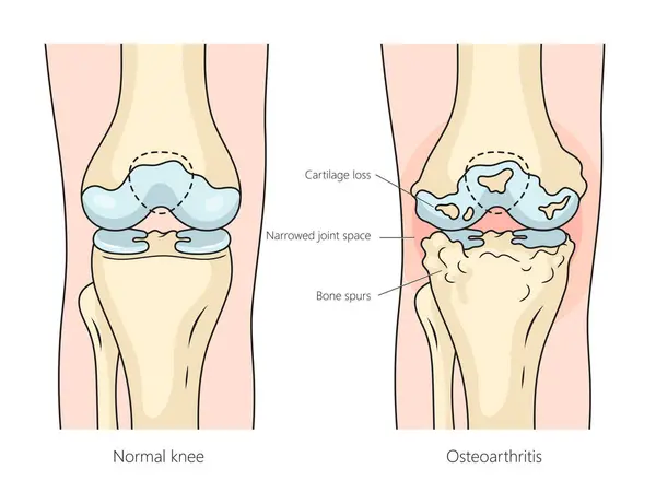 Osteoartritis Humana Artritis Reumatoide Rodilla Diagrama Estructura Articular Ilustración Trama — Foto de Stock