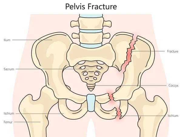 Pelvic pelvis fracture structure diagram hand drawn schematic raster illustration. Medical science educational illustration
