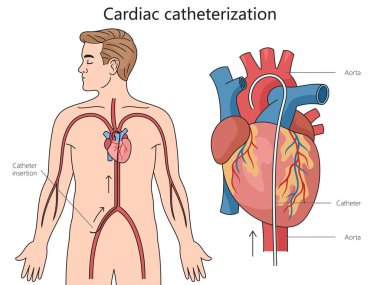 Cardiac catheterization structure diagram hand drawn schematic vector illustration. Medical science educational illustration clipart