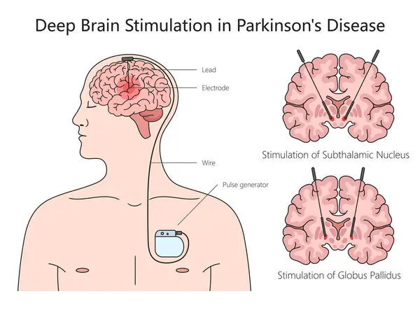 Deep Brain Stimulation Structure Parkinson Disease Diagram Hand Drawn Schematic — Stock Vector