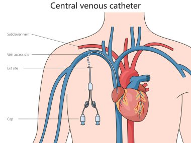 Merkezi venöz kateter yapı diyagramı el çizimi şematik vektör çizimi. Tıp bilimi eğitimsel illüstrasyon