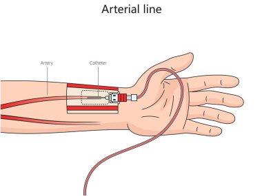 Arteriyel çizgi yapısı ince kateter bir arter diyagramı içine yerleştirilmiş şematik raster çizimi. Tıp bilimi eğitimsel illüstrasyon