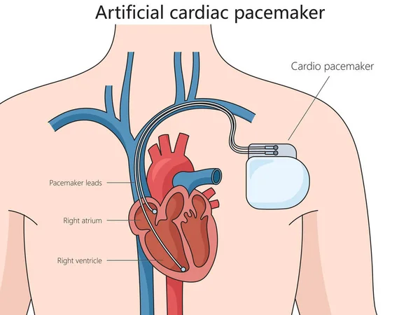 Artificial cardiac pacemaker medical device structure diagram hand drawn schematic raster illustration. Medical science educational illustration